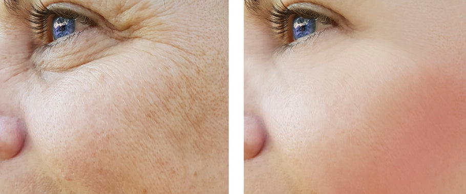 What Are The Main Causes of Hyperpigmentation?