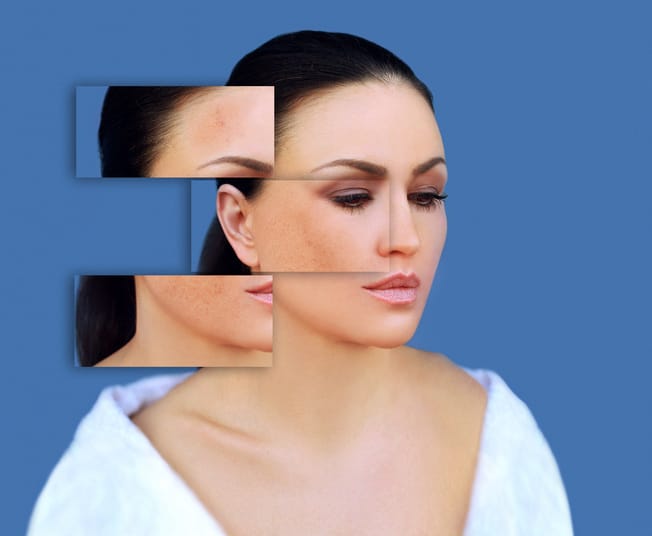 5 Natural Skincare Tips for Improving Hyperpigmentation